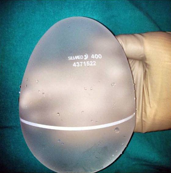 Silicone Buttock Implants 65