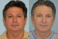 63 year-old gentleman with facelift and neck liposuction, seen before and one year postop