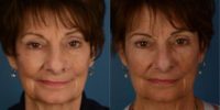 65-74 year old woman treated with Revision Rhinoplasty