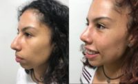 17 or under year old woman treated with Rhinoplasty