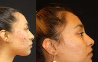 18-24 year old woman treated with Facial