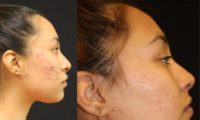 18-24 year old woman treated with Chemical Peel