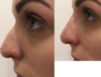 25-34 year old woman treated with Nonsurgical Nose Job