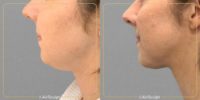 35-44 year old woman treated with AirSculpt