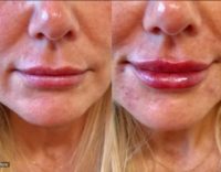 35-44 year old woman treated with Juvederm Ultra Plus