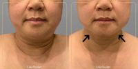 45-54 year old woman treated with AirSculpt