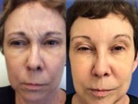 62 year old woman treated with Botox