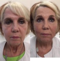 63 year old woman treated with Injectable Fillers