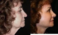 65-74 year old woman treated with Facelift, Rhinoplasty, Mini Neck Lift, Cheek Lift