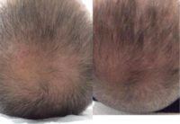 35-44 year old man treated with Hair Loss Treatment
