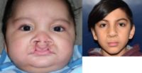 Patient treated with Cleft Lip and Palate Repair