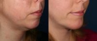 35-44 year old woman treated with Chin Implant