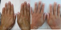 55-64 year old woman treated with Hand Rejuvenation