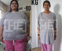 25-34 year old woman treated with Gastric Sleeve Surgery