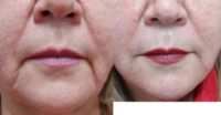 55-64 year old woman treated with Juvederm