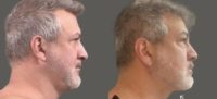 Man treated with AirSculpt