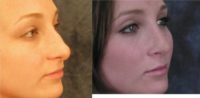 18-24 year old woman treated with Nose Surgery