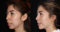 25-34 year old woman treated with Rhinoplasty, Chin Liposuction, Buccal Fat Removal