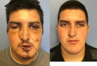 25-34 year old man treated with Facial Reconstructive Surgery