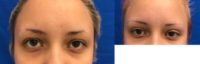 25-34 year old woman treated with Eyelid Surgery