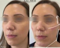 25-34 year old woman treated with Cheek Fillers