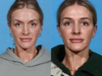 35 year old woman treated with Rhinoplasty