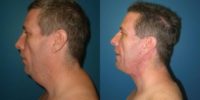 35-44 year old man treated with Neck Lift