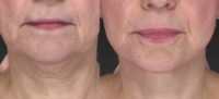 45-54 year old woman treated with Lower Face Lift