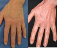 55-64 year old woman treated with Vein Treatment