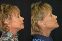 58 year old female with facial laxity, prior surgery
