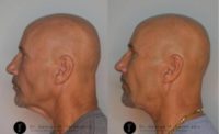 55-64 year old man treated with FaceTite