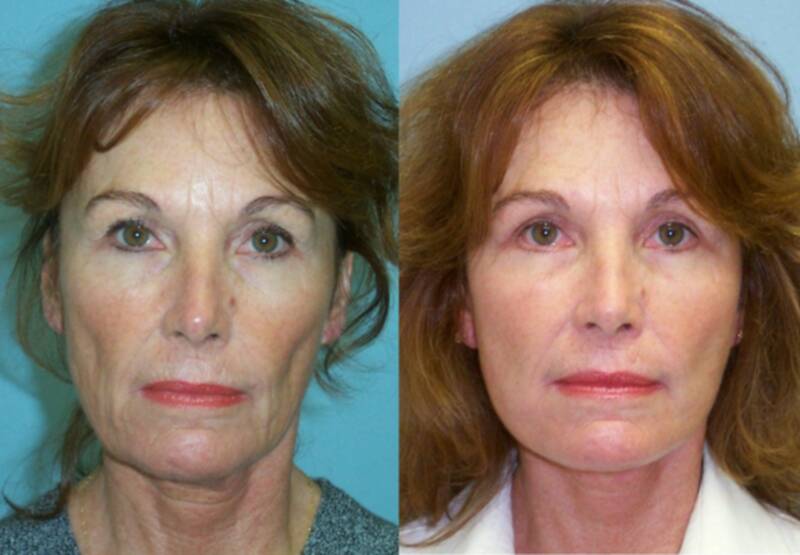 59 year-old woman underwent facelift and four lid blepharoplasty seen before and one year after