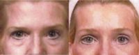 55-64 year old woman treated with Forehead Lift