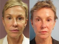 64 year old woman treated with Laser Resurfacing