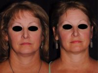 Autologous Fat Transfer and Precision TX facial liposuction to lower third of face