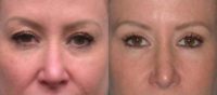 25-34 year old woman treated with Facelift