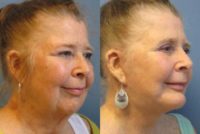 65-74 year old woman treated with SMAS Facelift.  Chin Augmentation, Eyelid Lift