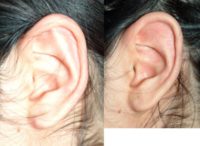 17 or under year old woman treated with Ear Surgery