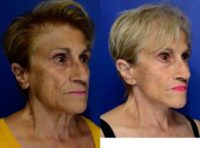 Face Lift, Neck Lift and Fat Grafting to Cheeks