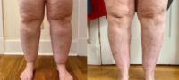 45-54 year old woman treated with Lipedema Surgery