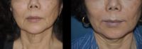 65-74 year old woman treated with Juvederm