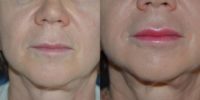 55-64 year old woman treated with Lip Augmentation