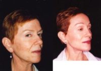 65-74 year old woman treated with Facelift Revision, Lip Surgery, Brow Lift