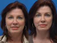 62 year-old female facelift