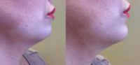 35-44 year old woman treated with Voluma for Chin Augmentation