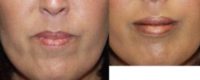 35-44 year old woman treated with Lip Implants