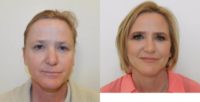45-54 year old woman treated with Facelift