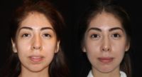 25-34 year old woman treated with Rhinoplasty, Chin Liposuction, Buccal Fat Removal