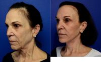 Face Lift, Neck Lift and Fat Grafting to Temples