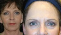 Facelift with Earlobe Reduction